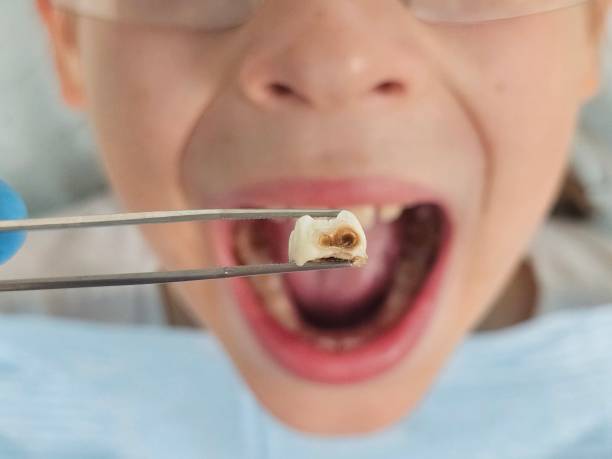 Best Emergency Dental Extractions in Belle, WV