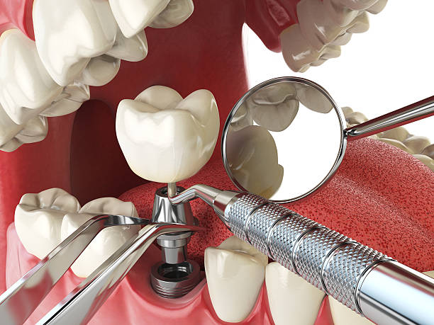 Best Emergency Dentist for Lost Fillings or Crowns in Belle, WV